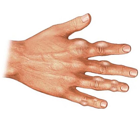 Dépôt de cristaux d'acide urique dans les tissus mous des doigts atteints d'arthrite goutteuse
