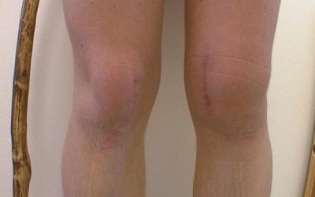 stades de développement de l'arthrose du genou