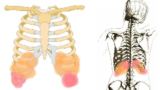 Les maux de dos sous les côtes Symptômes.