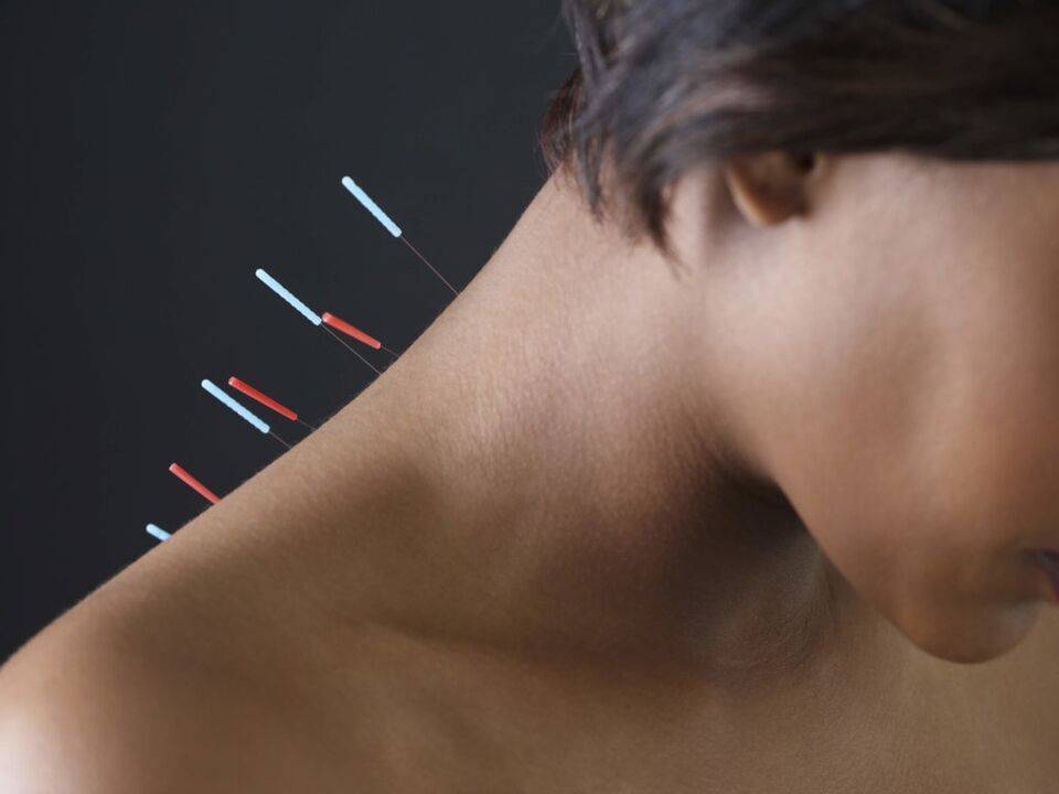 L'acupuncture pour l'ostéochondrose cervicale élimine les processus inflammatoires. 